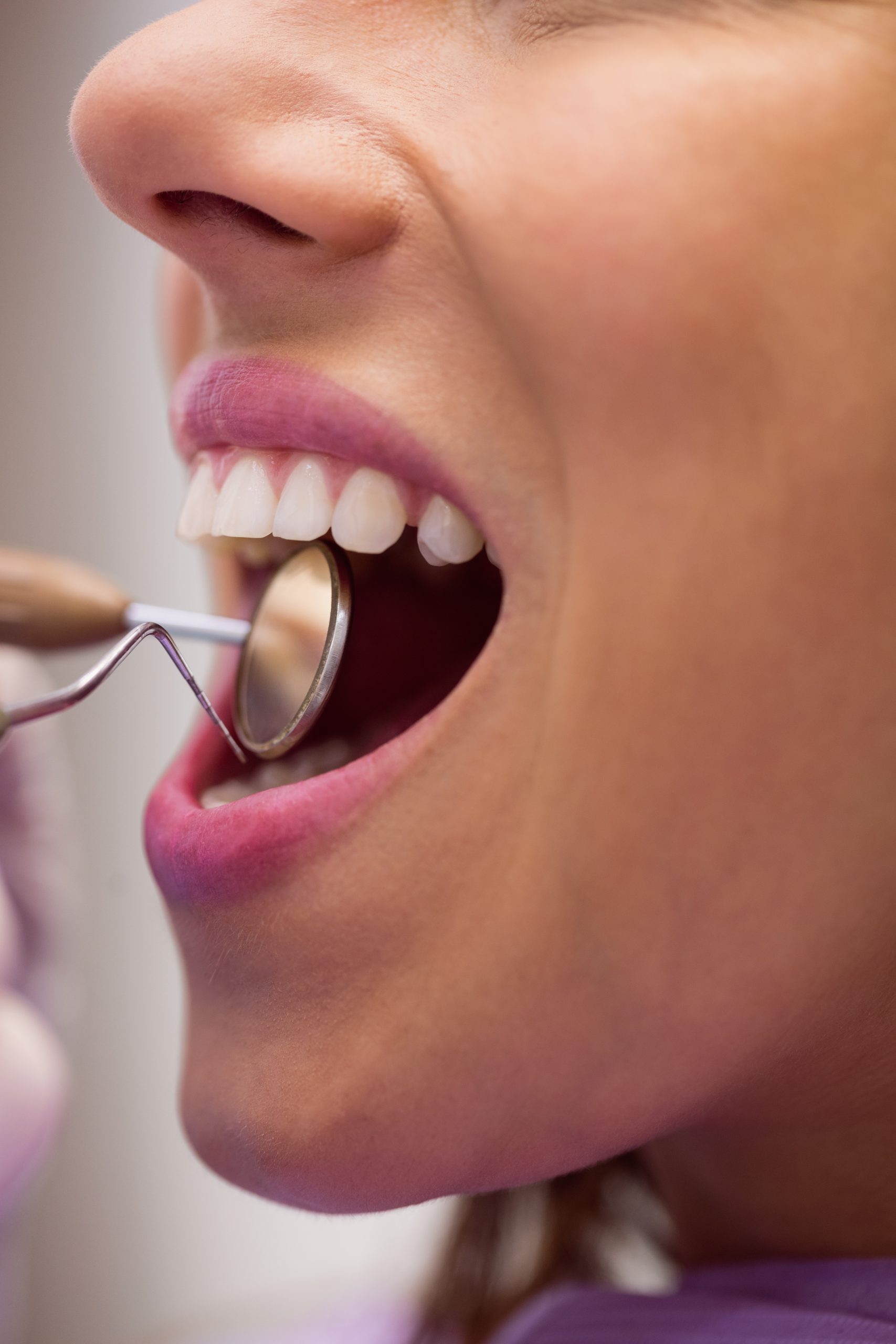 limpieza dental en san cugat del valles limpieza dental en san cugat del valles